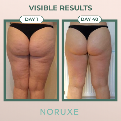 Noruxe™ Cellulite Relief Massager
